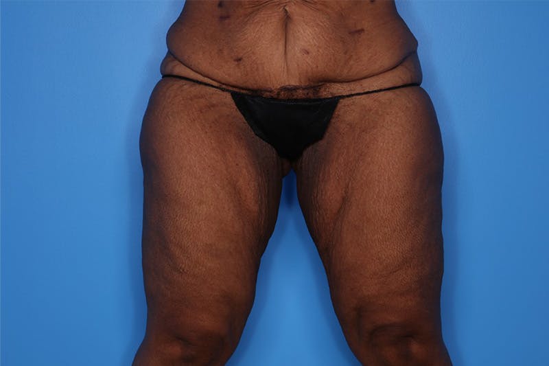 Liposuction Before & After Gallery - Patient 272098 - Image 3