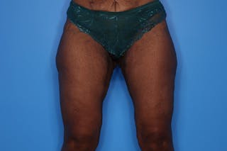 Liposuction Before & After Gallery - Patient 272098 - Image 4