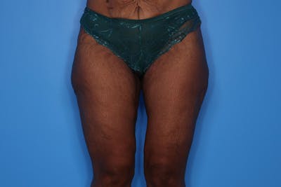 Thigh Lift Before & After Gallery - Patient 196712 - Image 2