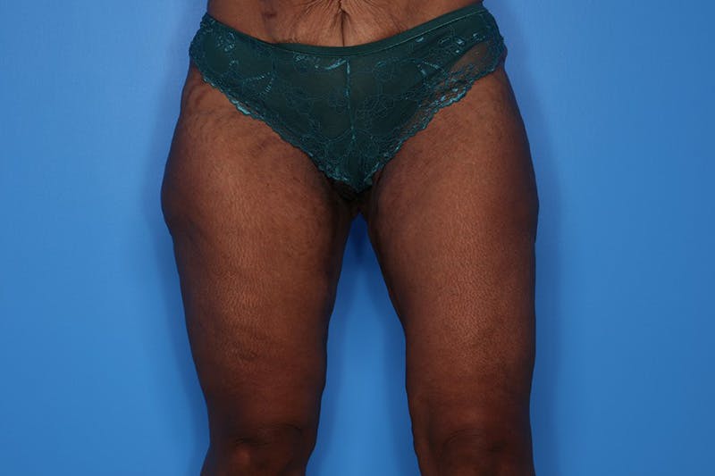 Liposuction Before & After Gallery - Patient 272098 - Image 5