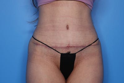Tummy Tuck Before & After Gallery - Patient 991436 - Image 2