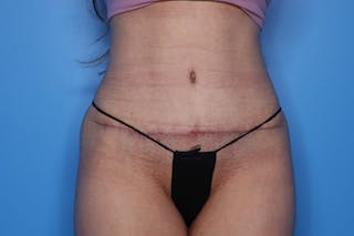 Liposuction Before & After Gallery - Patient 242765 - Image 2