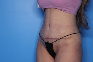Liposuction Before & After Gallery - Patient 242765 - Image 4