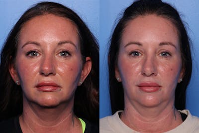 CO2 Laser Resurfacing Before & After Gallery - Patient 412173 - Image 1