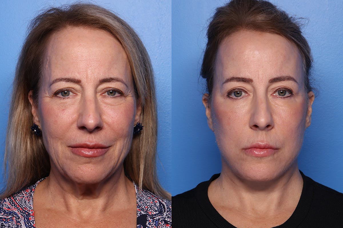 Facelift Before & After Gallery - Patient 110619 - Image 1