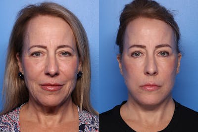 Facelift Before & After Gallery - Patient 110619 - Image 1