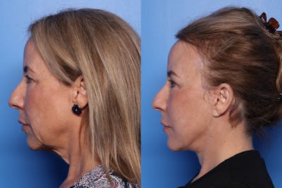Neck Lift Before & After Gallery - Patient 258661 - Image 1