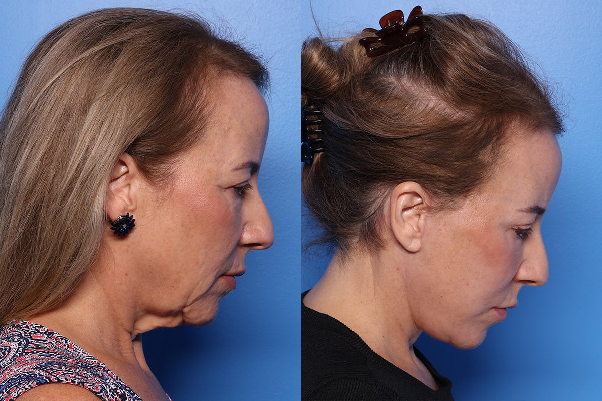 Facelift Before & After Gallery - Patient 110619 - Image 3