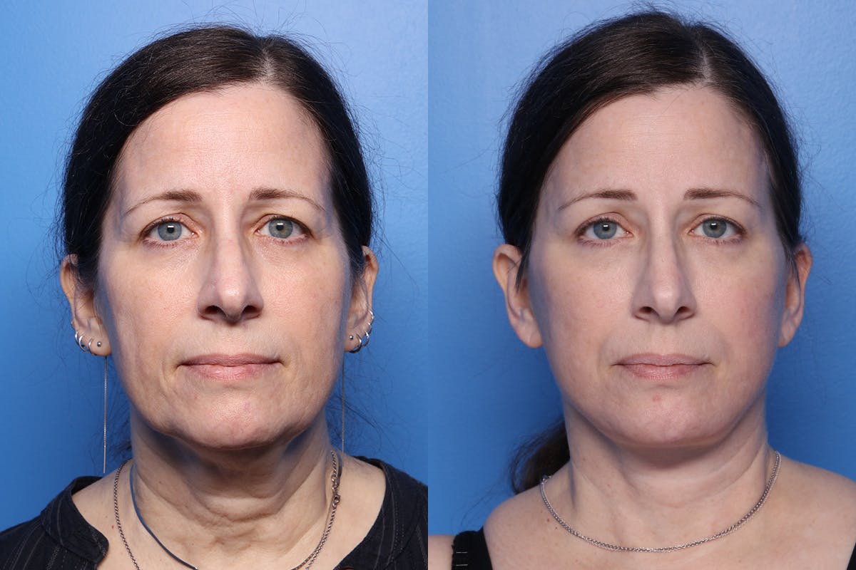 Facelift Before & After Gallery - Patient 167081 - Image 1