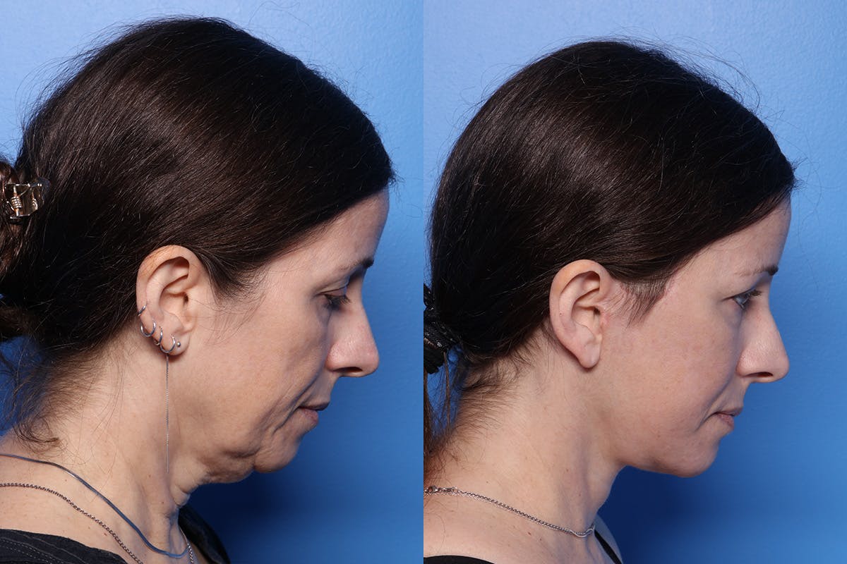 Facelift Before & After Gallery - Patient 167081 - Image 3