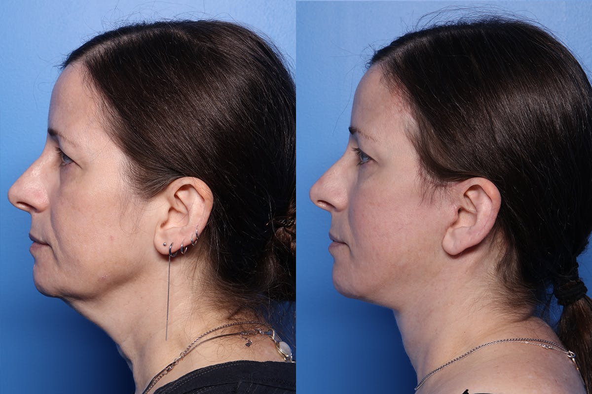 Facelift Before & After Gallery - Patient 167081 - Image 4