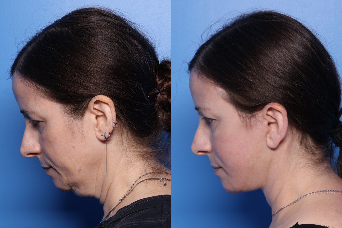 Facelift Before & After Gallery - Patient 167081 - Image 5