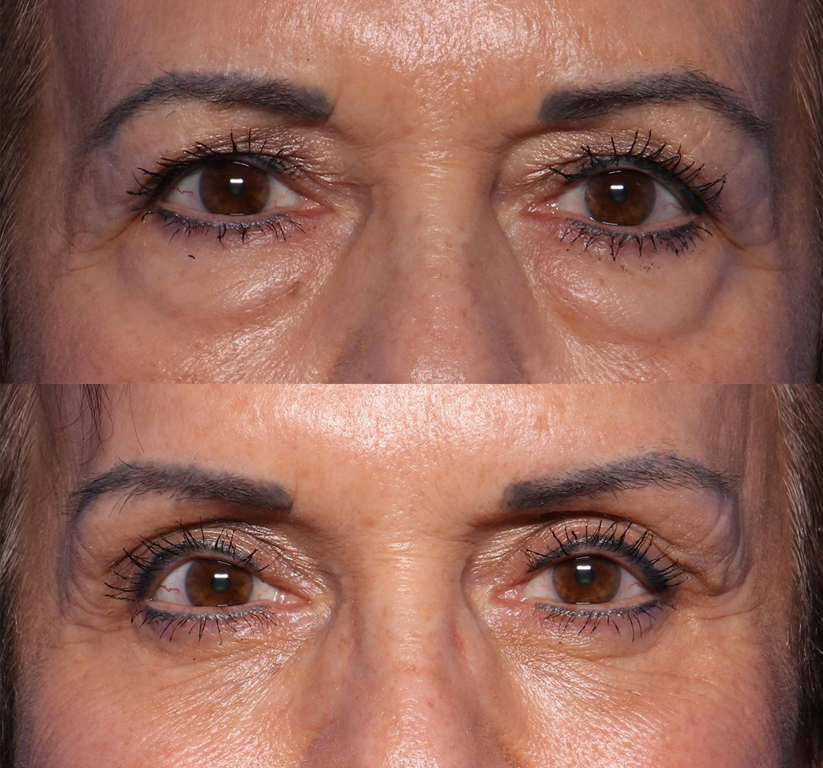 Blepharoplasty Before & After Gallery - Patient 224556 - Image 1