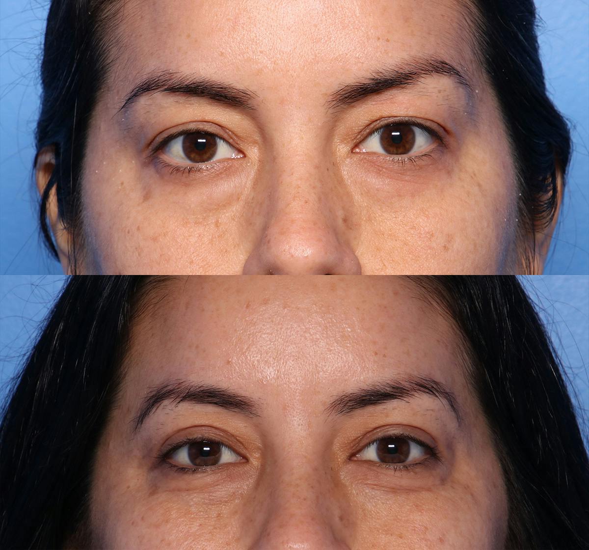 Blepharoplasty Before & After Gallery - Patient 254258 - Image 1