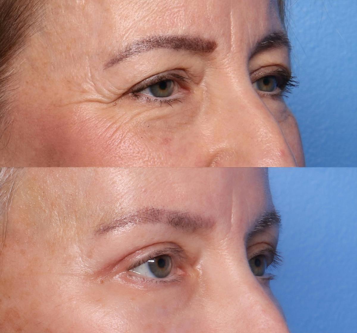 Blepharoplasty Before & After Gallery - Patient 186594 - Image 2