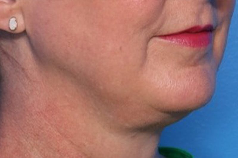 FaceTite Before and After Before & After Gallery - Patient 327809 - Image 1