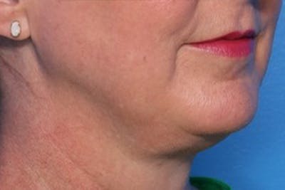 FaceTite Before and After Before & After Gallery - Patient 327809 - Image 1