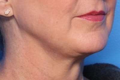 Morpheus8® Before & After Gallery - Patient 296974 - Image 2