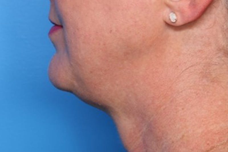 FaceTite Before and After Before & After Gallery - Patient 327809 - Image 3