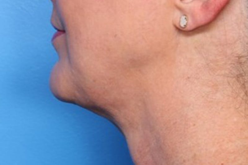 FaceTite Before and After Before & After Gallery - Patient 327809 - Image 4