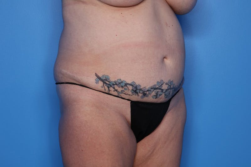 BodyTite™ Before and After Before & After Gallery - Patient 406919 - Image 3