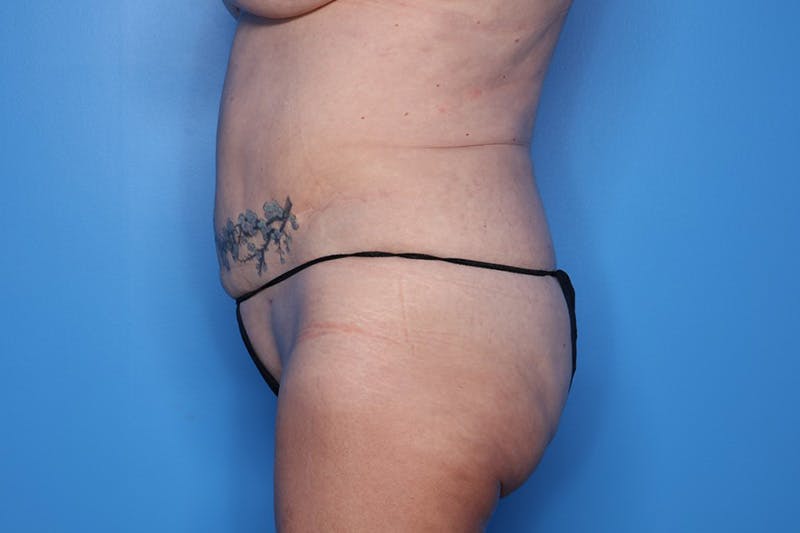 BodyTite™ Before and After Before & After Gallery - Patient 406919 - Image 6