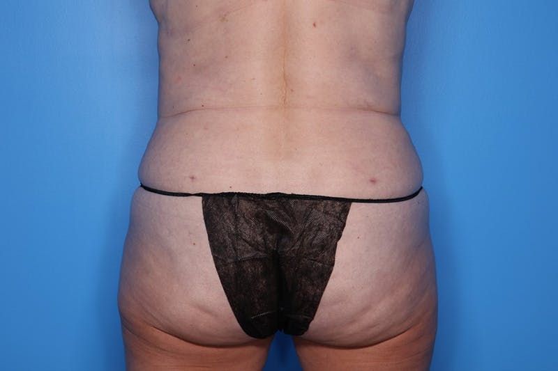 BodyTite™ Before and After Before & After Gallery - Patient 406919 - Image 8