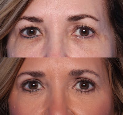Blepharoplasty Before & After Gallery - Patient 273343 - Image 1
