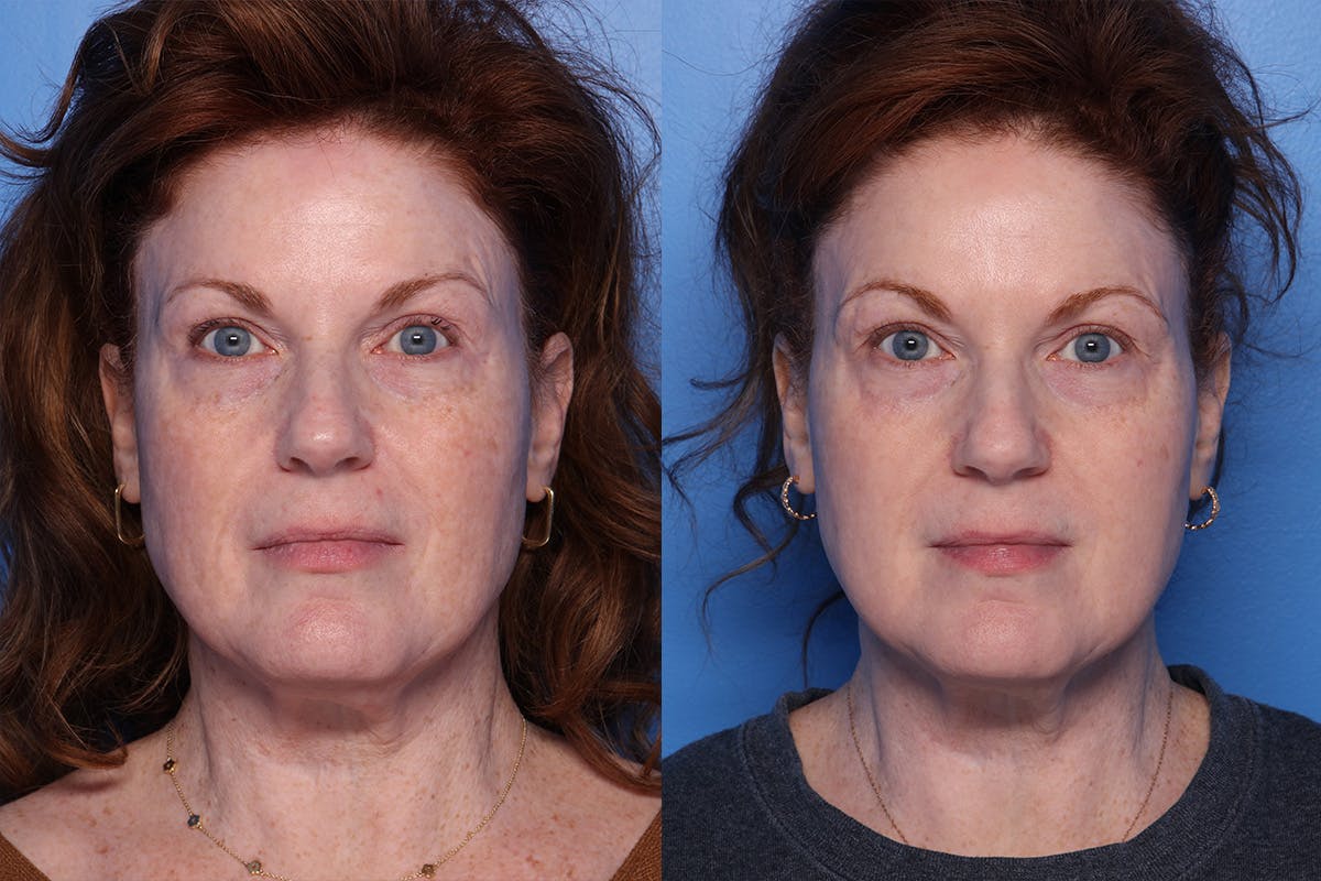 CO2 Laser Resurfacing Before & After Gallery - Patient 242777 - Image 1