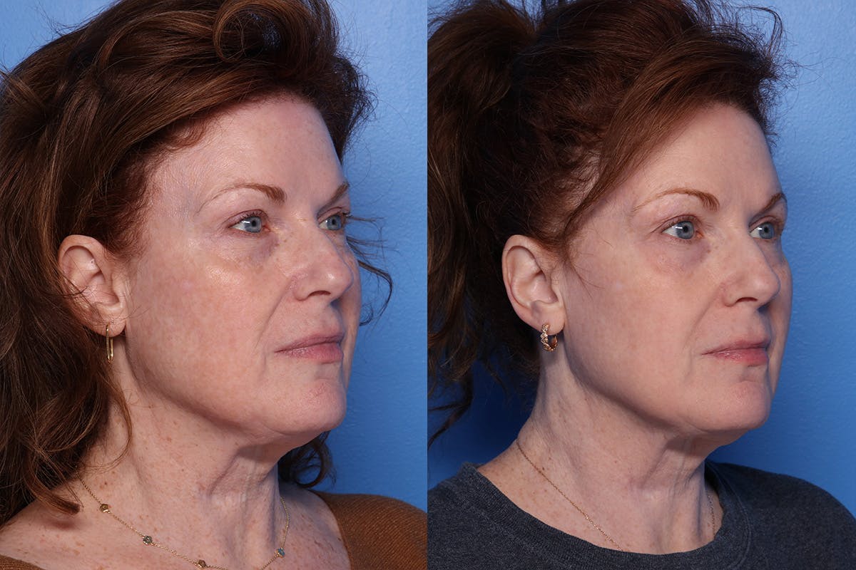 CO2 Laser Resurfacing Before & After Gallery - Patient 242777 - Image 2