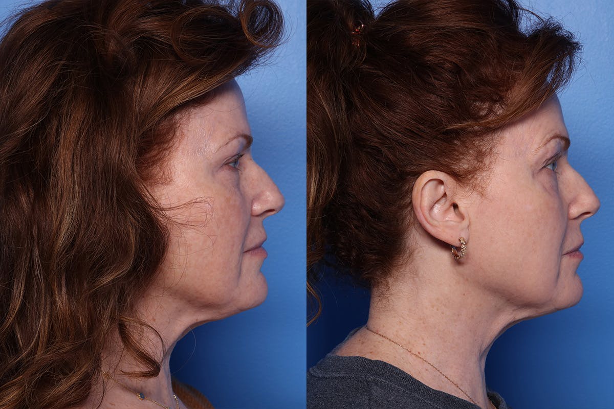CO2 Laser Resurfacing Before & After Gallery - Patient 242777 - Image 3