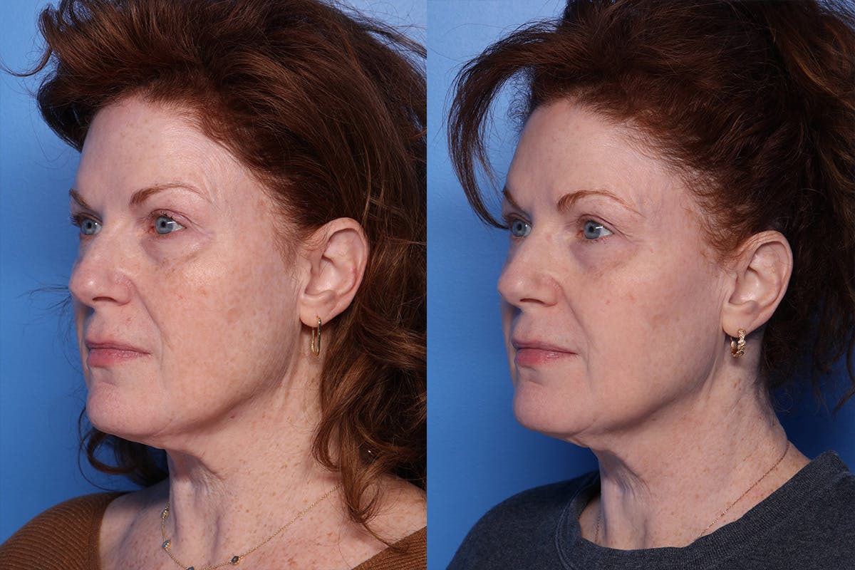 CO2 Laser Resurfacing Before & After Gallery - Patient 242777 - Image 4