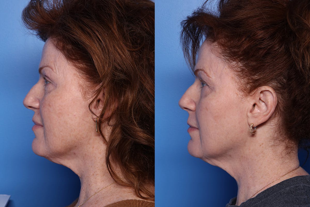 CO2 Laser Resurfacing Before & After Gallery - Patient 242777 - Image 5
