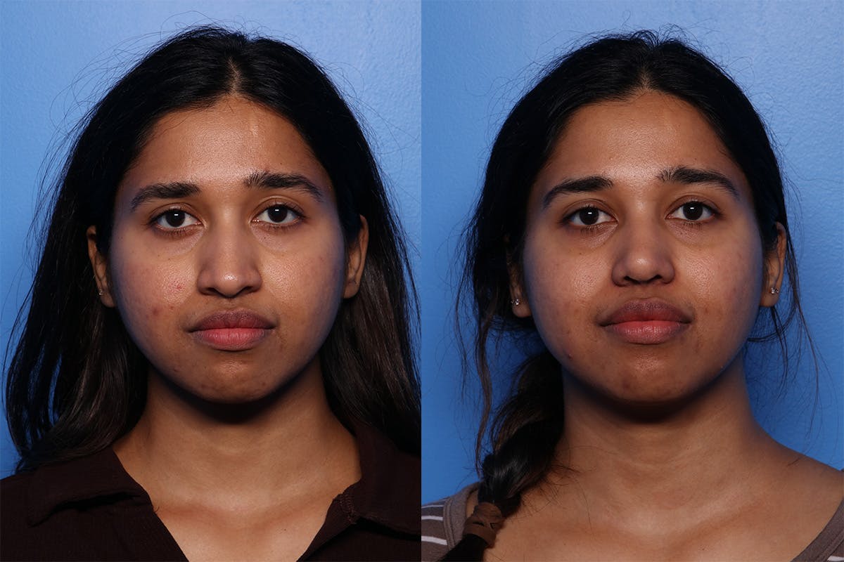 Rhinoplasty Before & After Gallery - Patient 339269 - Image 1