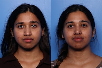 Rhinoplasty Before & After Gallery - Patient 339269 - Image 1