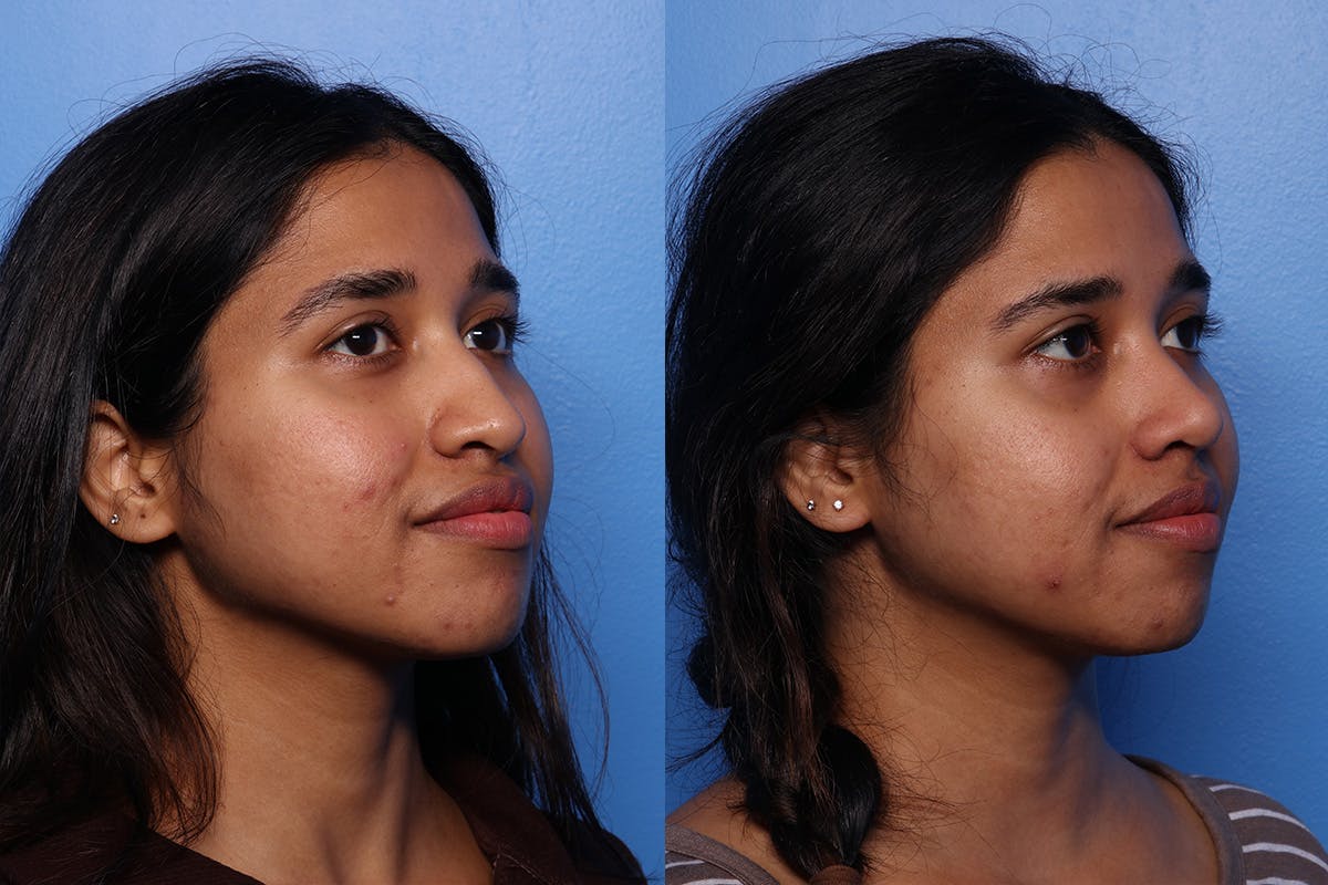 Rhinoplasty Before & After Gallery - Patient 339269 - Image 2