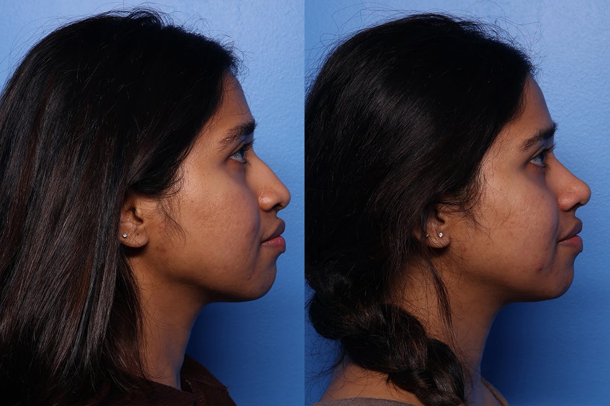 Rhinoplasty Before & After Gallery - Patient 339269 - Image 3