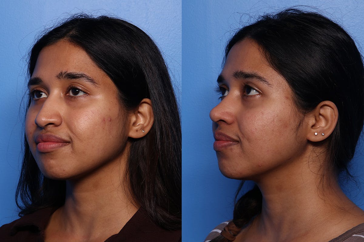 Rhinoplasty Before & After Gallery - Patient 339269 - Image 4