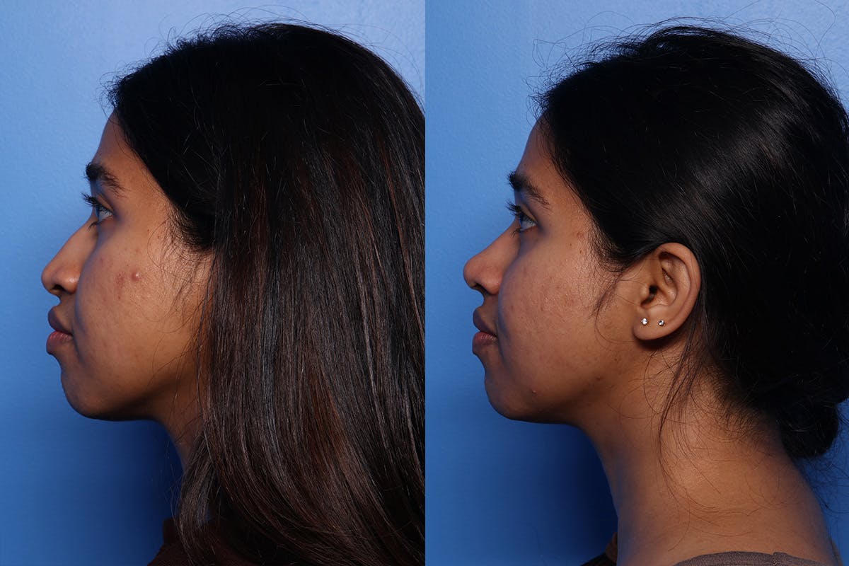 Rhinoplasty Before & After Gallery - Patient 339269 - Image 5