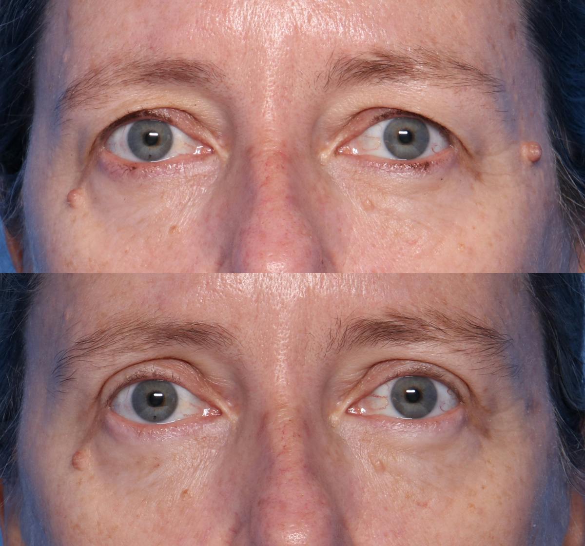 Blepharoplasty Before & After Gallery - Patient 140543 - Image 1