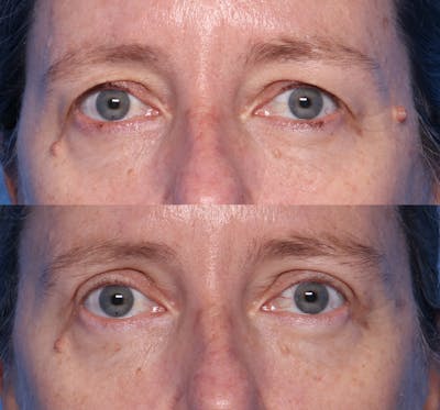 Blepharoplasty Before & After Gallery - Patient 140543 - Image 1