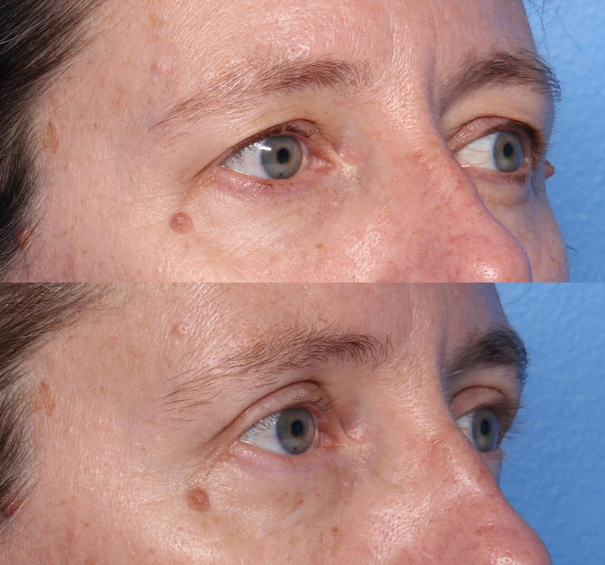 Blepharoplasty Before & After Gallery - Patient 140543 - Image 2