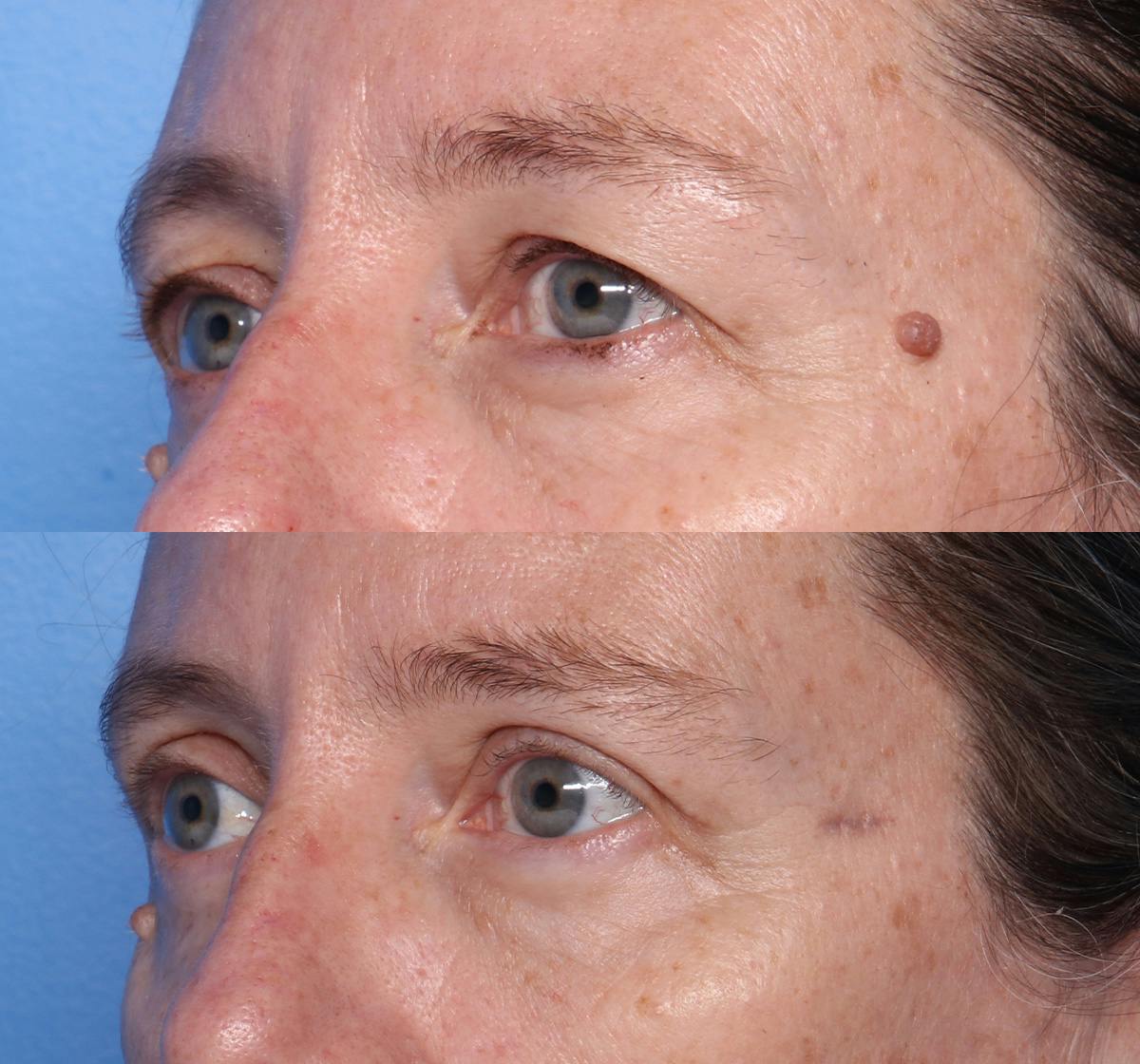 Blepharoplasty Before & After Gallery - Patient 140543 - Image 3