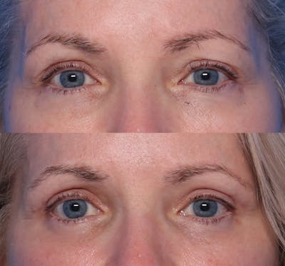 Blepharoplasty Before & After Gallery - Patient 426118 - Image 1