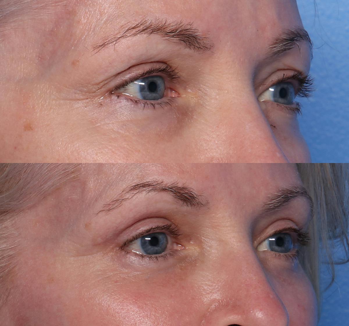 Blepharoplasty Before & After Gallery - Patient 426118 - Image 2