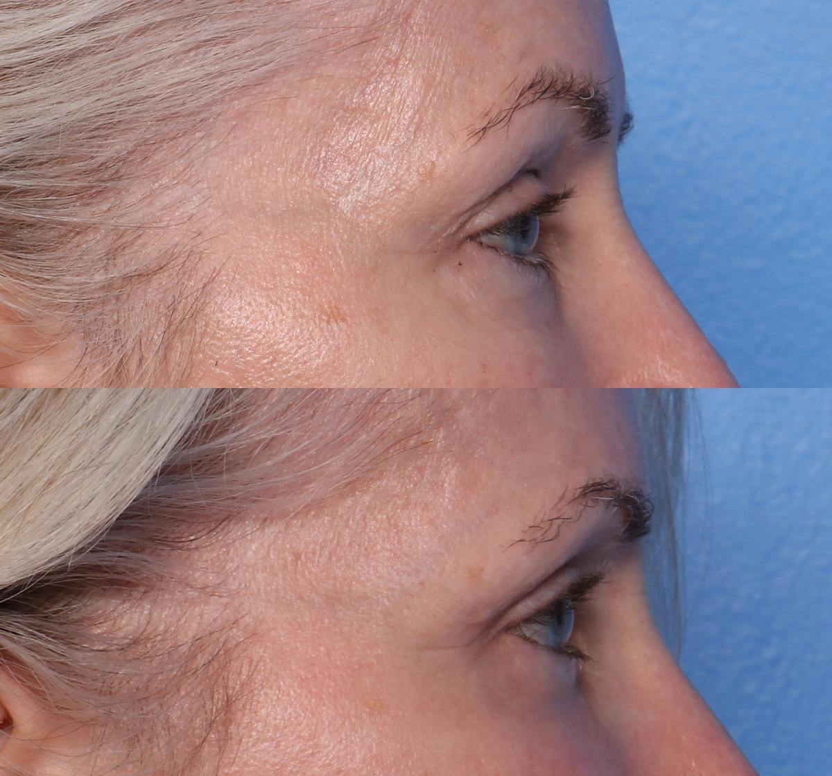 Blepharoplasty Before & After Gallery - Patient 426118 - Image 3