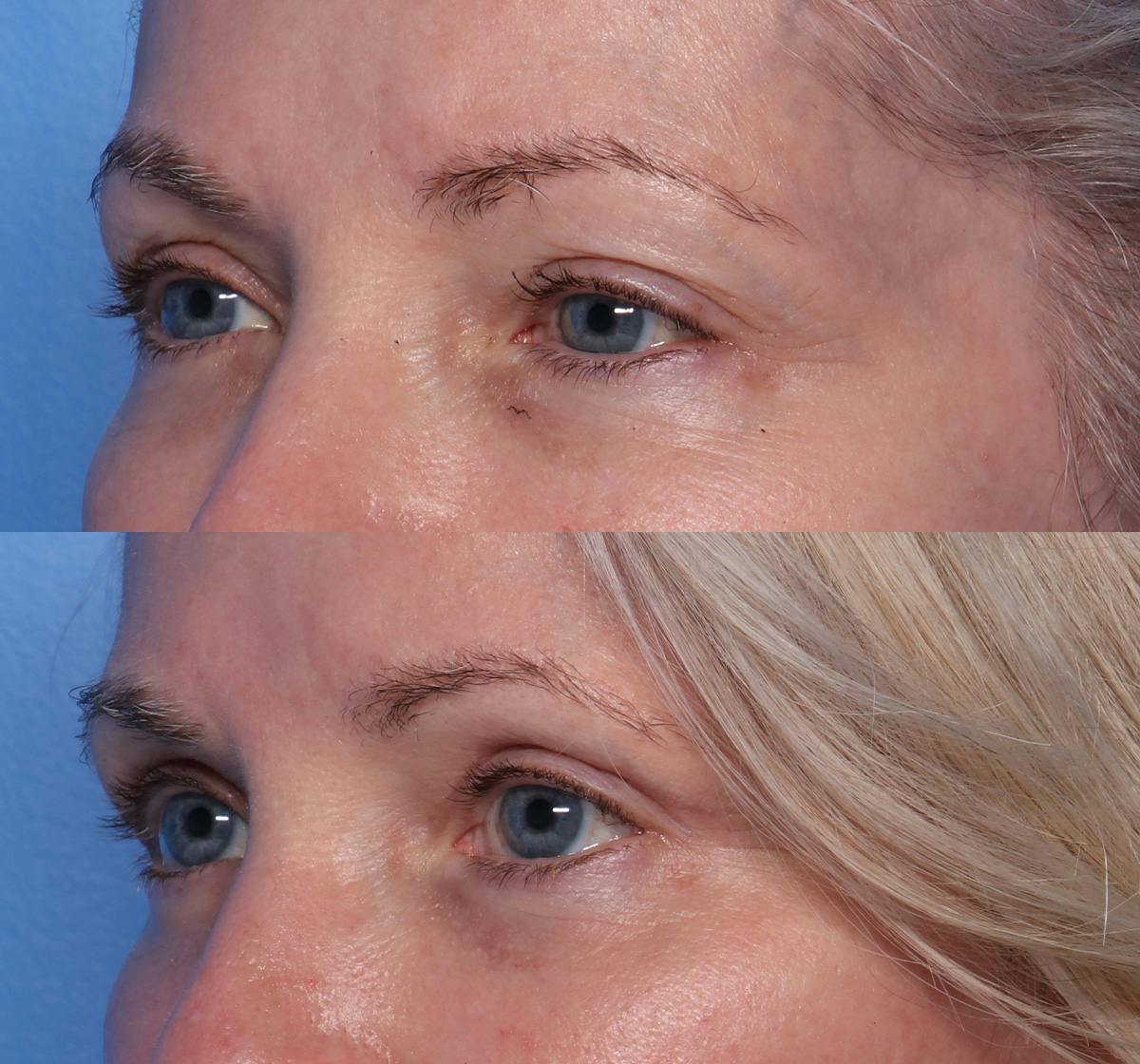 Blepharoplasty Before & After Gallery - Patient 426118 - Image 4