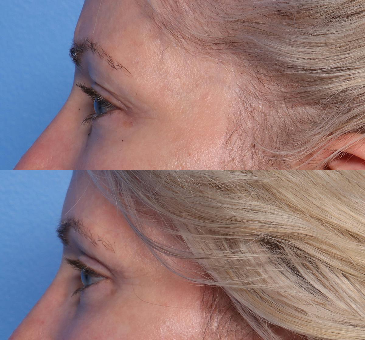 Blepharoplasty Before & After Gallery - Patient 426118 - Image 5
