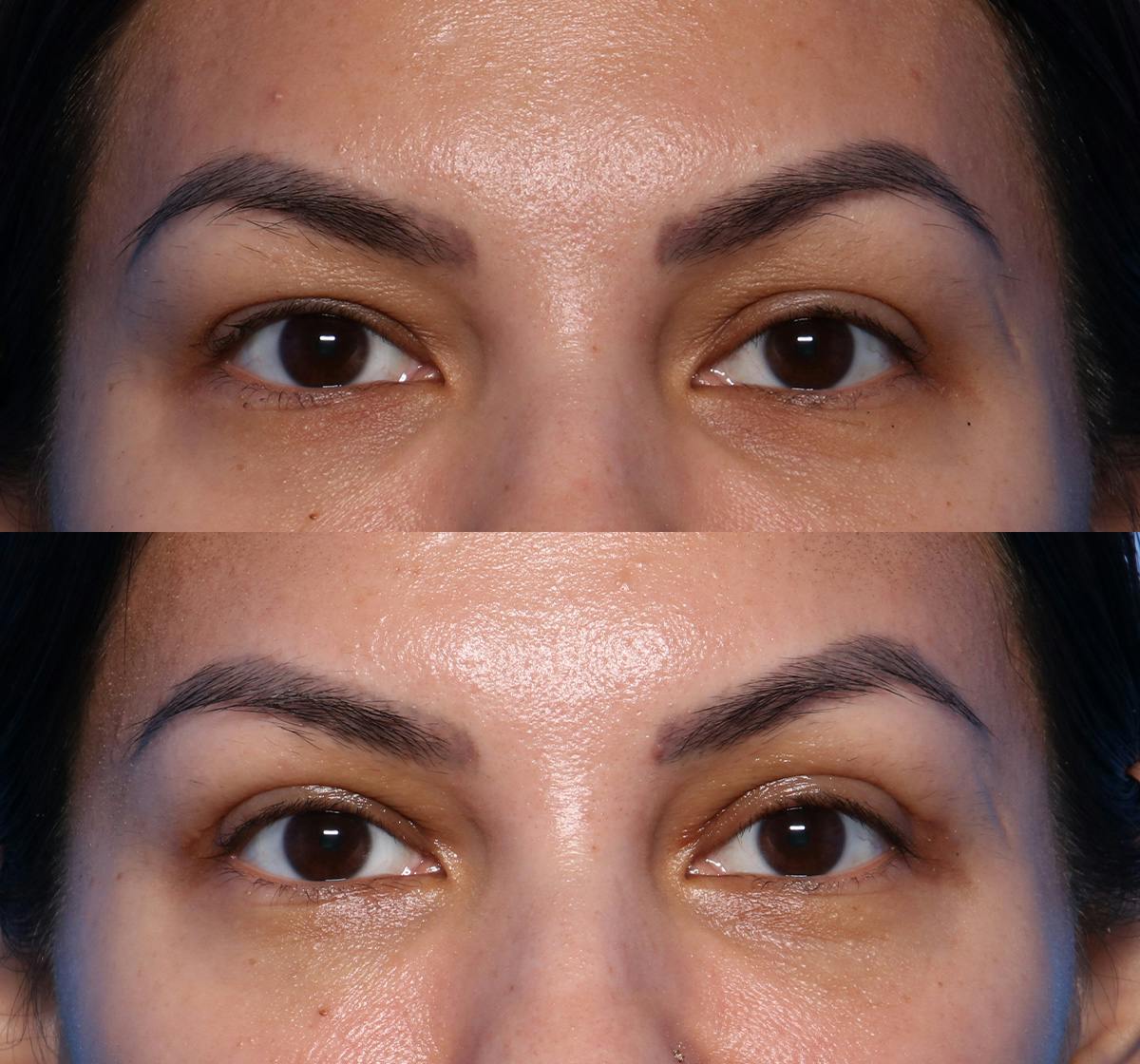 Blepharoplasty Before & After Gallery - Patient 390627 - Image 1