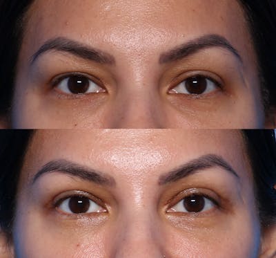 Blepharoplasty Before & After Gallery - Patient 390627 - Image 1